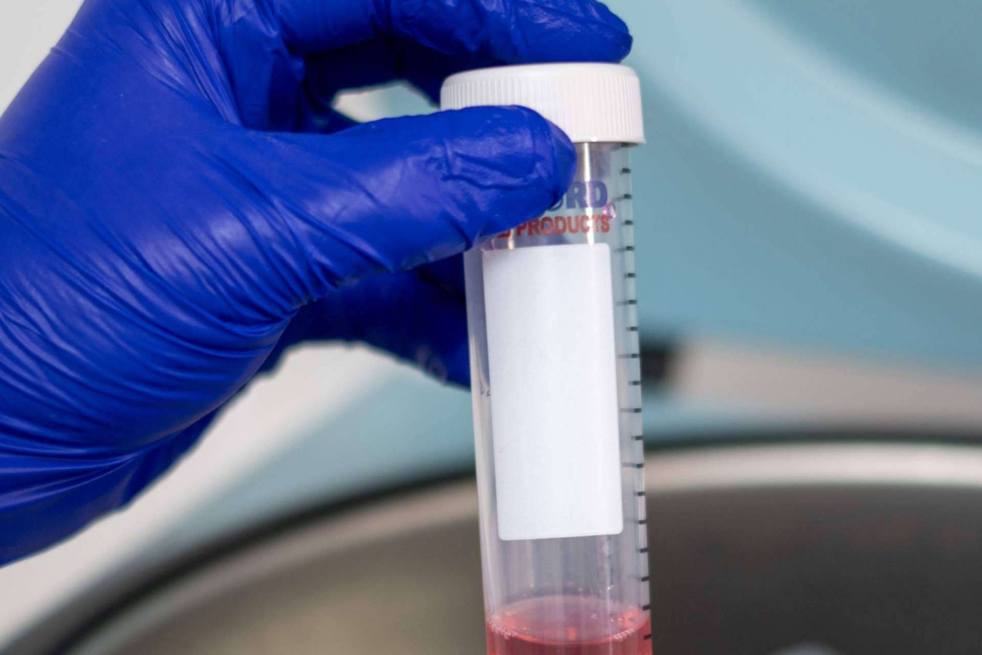 La nueva biotecnología para pacientes con cáncer en etapa 3 y 4; Inmunoterapia personalizada DEXs de Oncovix